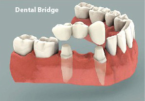 Dental bridges
